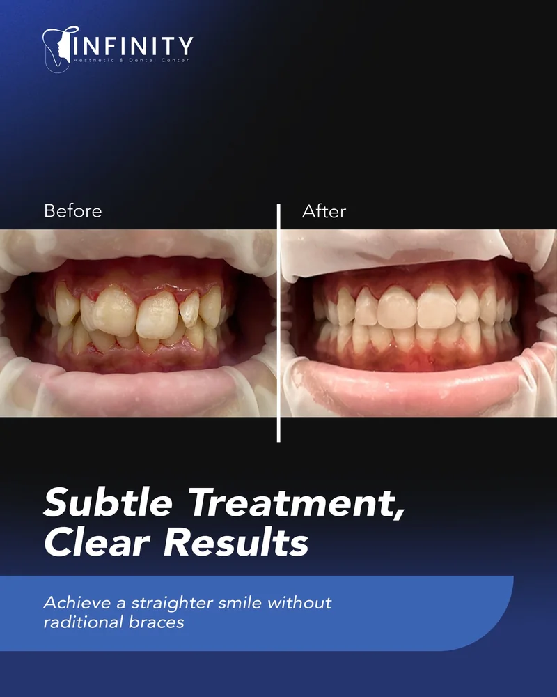 Crowding corrected with clear aligners at Infinity Dental Clinic Dubai