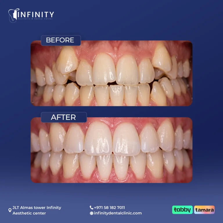 Alignment and spacing corrected at Infinity Dental Clinic Dubai