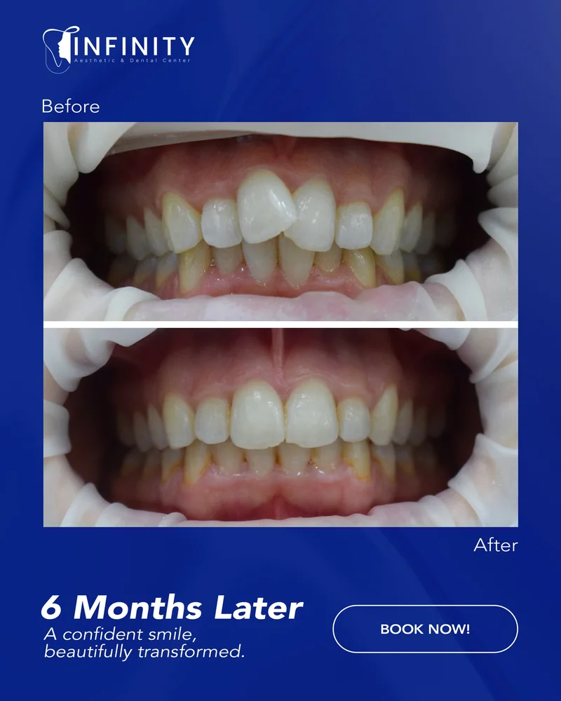 Alignment and spacing corrected at Infinity Dental Clinic Dubai