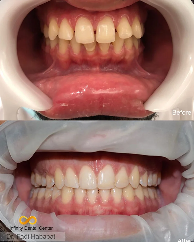 Alignment corrected over six months at Infinity Dental Clinic Dubai