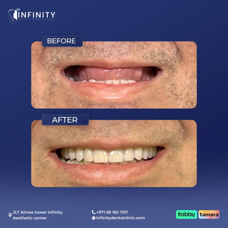 Single implant with zirconia crown at Infinity Dental Clinic Dubai