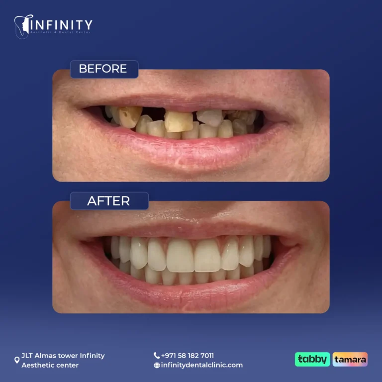 Multiple implants with a fixed bridge at Infinity Dental Clinic Dubai