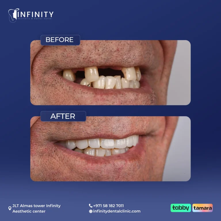 Full-arch implant rehabilitation at Infinity Dental Clinic Dubai